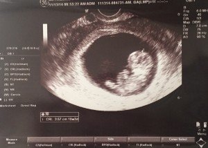 10 Week Ultrasound