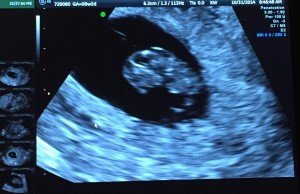 Week 8 Ultrasound